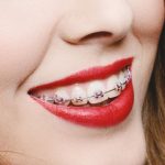 aparaty-ortodontyczne-dla-doroslych